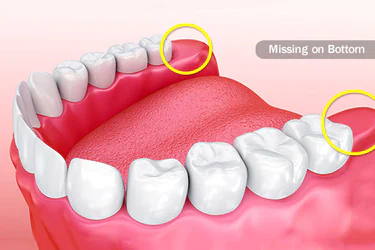 Wisdom teeth causing tooth pain
