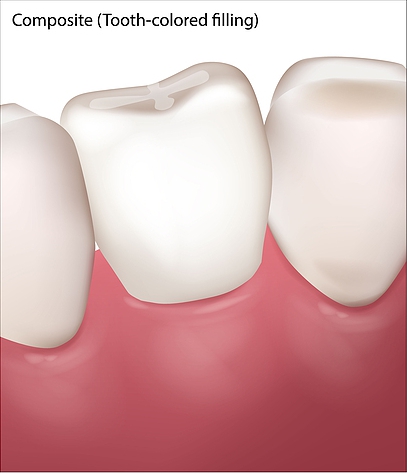 Tooth-fillings-composite