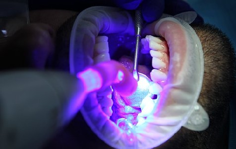 Emergency Root Canal